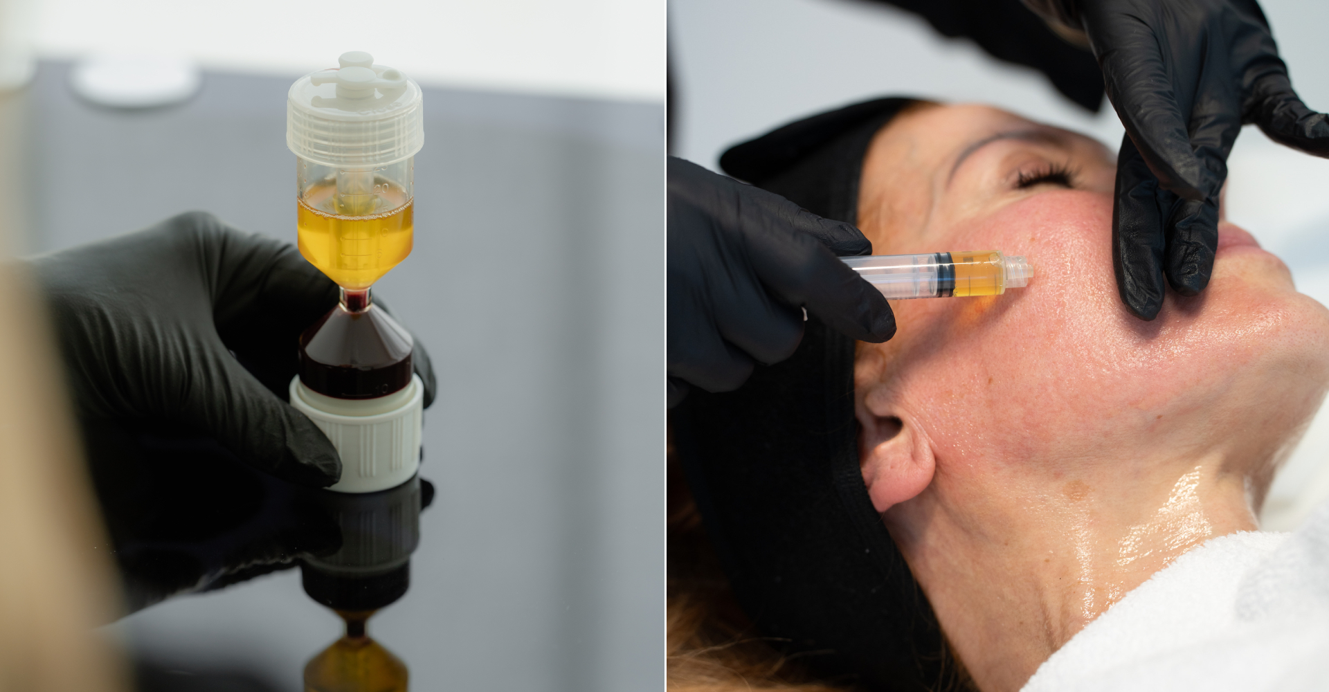 Revitalize Your Skin with Autologous Plasma Gel, at Skin Atelier Kilchberg.